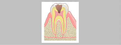虫歯C1