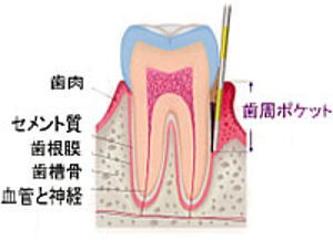 歯周ポケット