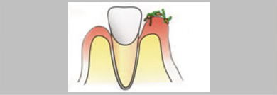 カビが歯ぐきについて根を下ろし炎症を起します。