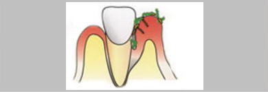 歯と歯ぐきの間にポケットができます。歯周ポケットといいます。