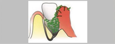 骨はさらに解け歯周ポケットはさらに深くなり、さらに多くの菌がたまっていきます。