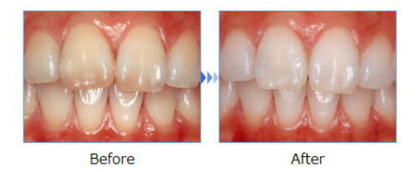 歯の色が気になっていた方へのホワイトニング審美治療