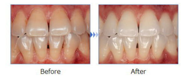 歯の色が気になっていた方へのホワイトニング審美治療